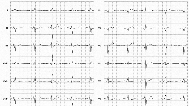 Fusion of ventricular and normal beats 12 Lead EKG
